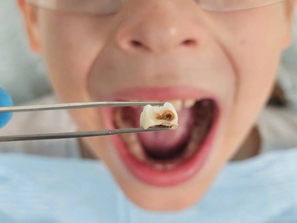 Best Emergency Tooth Extraction in Olivet, TN